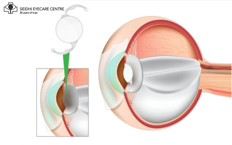 cataract surgery in bengaluru