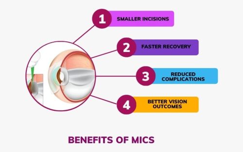 cataract surgery in bengaluru