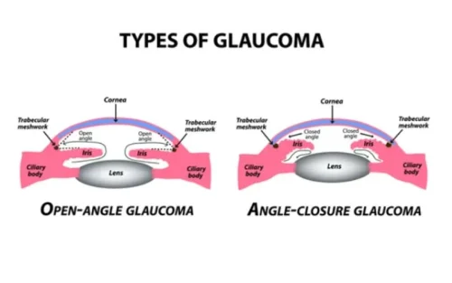 best glaucoma specialist in bangalore